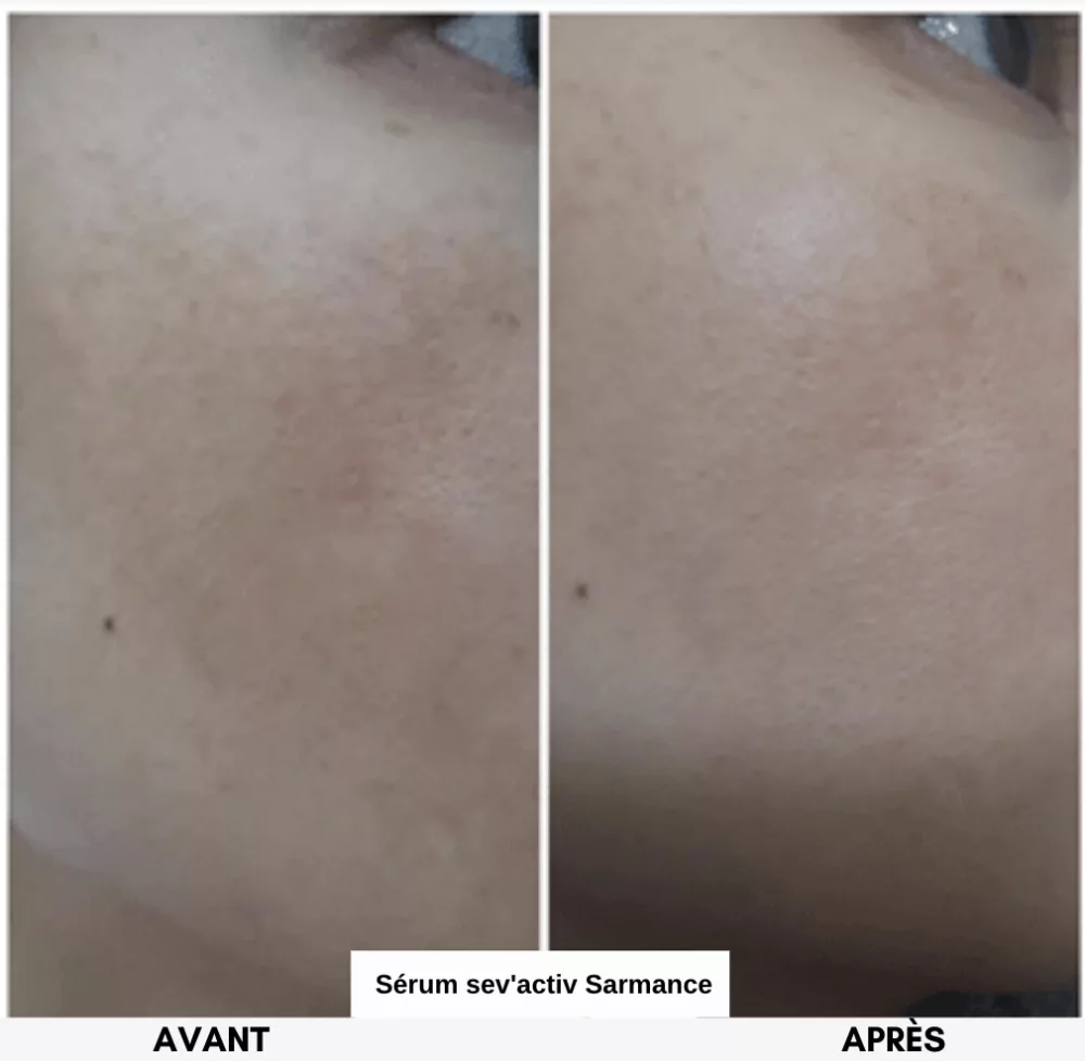 Masque de grossesse, mélasma, taches pigmentaires, cicatrices d'acné